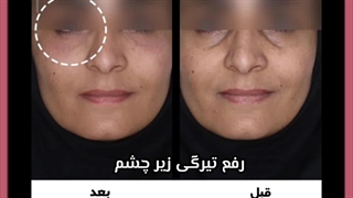 رفع تیرگی دور چشم لیزر مو