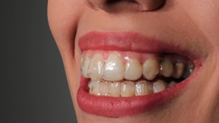 ارتودنسی نامرئی چیست؟