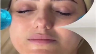 مراحل فیشیال صورت پوسیدگی دندان