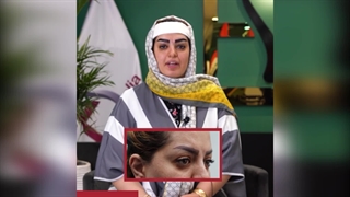 تجربه کاشت ابرو در کلینیک هلیا با نتایج رضایت بخش