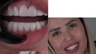 قیمت کامپوزیت دندان در مشهد