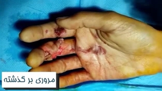 نتیجه درمان پارگی تاندون فلکسور عمقی