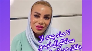 ۷ ماه بعد از سانترال لب و بلفارو در کلینیک آرتین