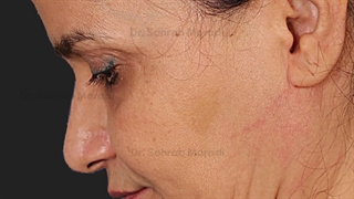 لیفت صورت و لیفت گردن