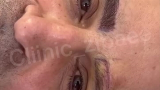 کاشت ابرو در کلینیک آرتین