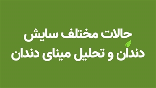 حالات مختلف سایش دندان (تحلیل مینای دندان)