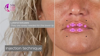 آموزش تزریق ژل پرفکتا دیپ به لب