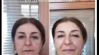 لیفتینگ و جوانسازی پوست با دستگاه پزشکی آفرودیت