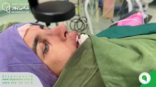 عمل جراحی زیبایی بینی به صورت نچرال و طبیعی | دکتر مسعود جانی پور روکش دندان