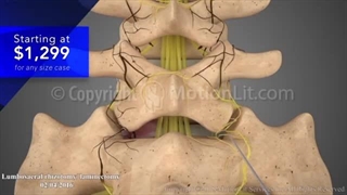 جراحی کمر - لامینکتومی - انیمیشن پزشکی سه بعدی