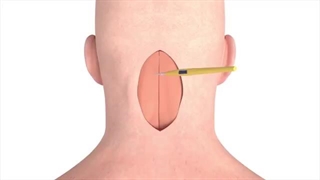 جراحی مغز کرانیکتومی - انیمیشن سه بعدی