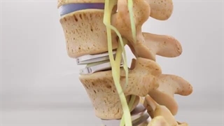 انیمیشن تعویض دیسک توتال کمر | آرتروپلاستی دیسک