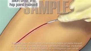 جراحی تعویض کامل هیپ: انیمیشن پزشکی