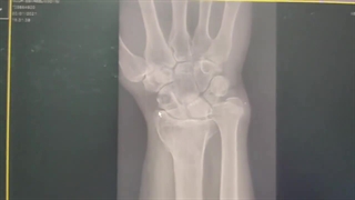 جراحی شکستگی مچ دست قدیمی