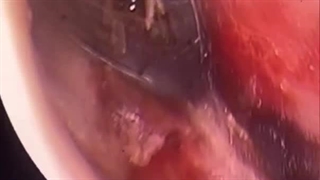 هنرنمایی یک عنکبوت در داخل گوش مرد چینی