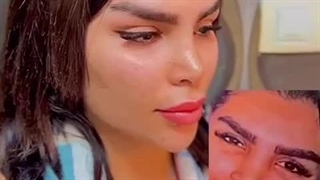 لیفت ابرو در کلینیک آرتین