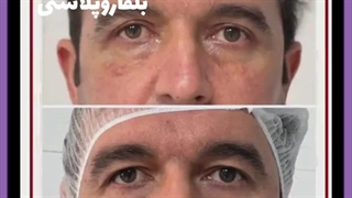 بلفاروپلاستی توسط پزشک عمومی