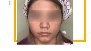 پاکسازی و جوانسازی پوست لیزر فرکشنال