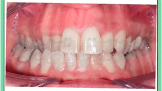 هزینه ارتودنسی یک دندان نیش