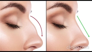 بهترین جراح بینی گوشتی