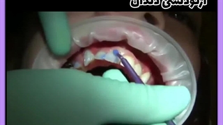 قیمت ارتودنسی چهار دندان جلو