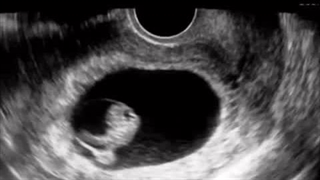 سونوگرافی هفته اول الی سی و هشتم بارداری