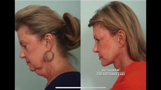 توضیحات کامل جراحی لیفت گردن