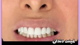 با لمینت دندان میشه غذا خورد