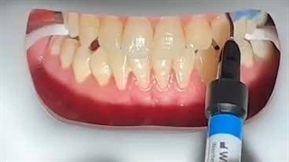 بلیچینگ دندان