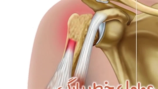 عوامل خطر پارگی تاندون های شانه | دکتر طاهریان