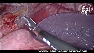 درمان آشالازی