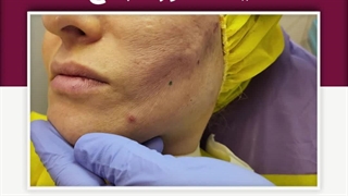 لیفت صورت با نخ لمینت