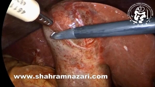 گانگرن کیسه صفرا