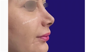 نتیجه جراحی زیبایی بینی پس از 16 سال | دکتر خوروش