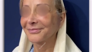 یک ماه پس از لیفت صورت و گردن ، لیفت باز پیشانی و عمل 4پلک