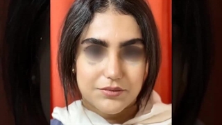 نتیجه عمل بینی نیمه فانتزی