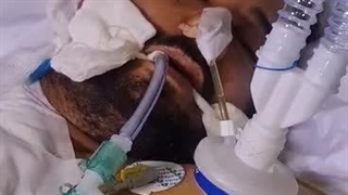 عمل جراحی موفقیت آمیز پیوند سر قطع شده برای اولین بار در ایران