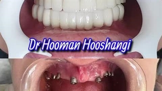 ایمپلنت در تهران