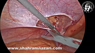 لیپوم کورد در فتق اینگوینال