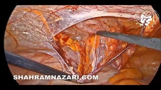 لیپوم کورد در فتق اینگوینال