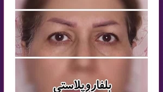 جراح پلک در شرق تهران