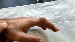 جراحی توده روی انگشت دست