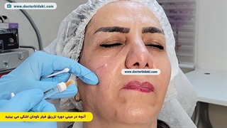 آموزش تزریق فیلر زیر چشم | دکتر بیدکی