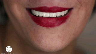 ایمپلنت فول فک بالا