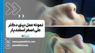 دکتر علی اصغر اسفندیار بهترین جراح بینی ساری درمان جای جوش