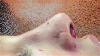 نمونه جراحی رینو پلاستی