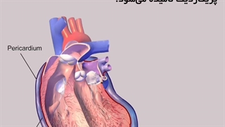 آیا شما میدانید پریکاردیت چیست؟