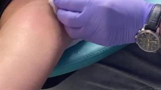 تزریق بوتاکس زیر بغل (بوتاکس تعریق)