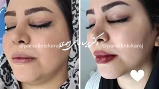 تزریق نیم سی سی فیلر لب در درمانگاه شبانه روزی پارس ( کرج )