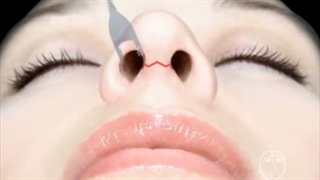 مراحل عمل بینی